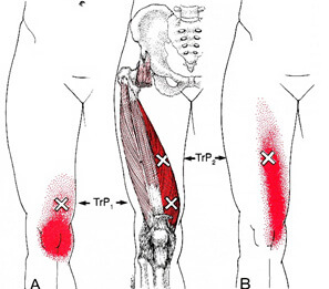 膝の痛みトリガーポイント