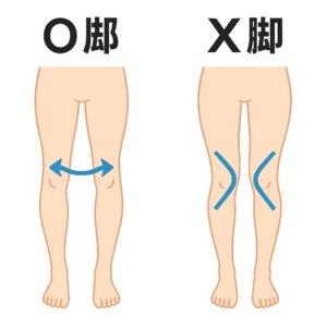足のゆがみ